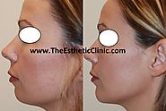 Chin Augmentation Surgery in Mumbai, India - The Esthetic Clinics