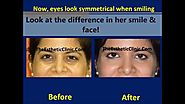 Dark Circles Under Eye Treatment in Mumbai India by Botox & Juvederm Filler Injections