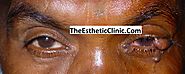 Eyelid Cancer Surgery in Mumbai, India - The Esthetic Clinics