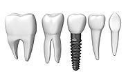 Top 5 Reasons to Select Dental Implants in Houston- Vita Dental