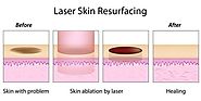 Laser Skin Resurfacing Treatment in Whitefield | Koramangala | Bangalore