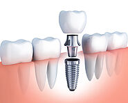 Trồng răng Implant mất bao lâu? Giải đáp chi tiết theo từng giai đoạn điều trị tại Nha khoa Sing