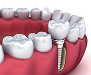Trồng răng Implant mất bao lâu?