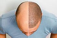 Hair Treatment in Ahmedabad, Gujarat