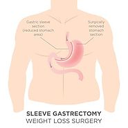 Laparoscopic Sleeve Gastrectomy: All You Need To Know