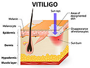 Vitiligo Treatment | White Patch Treatment in Whitefield | Koramangala | Bangalore