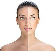 Website at http://www.skinspecialistinbangalore.in/skin-treatment/pigmentation-treatment-in-bangalore/