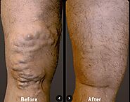BEFORE AND AFTER VEIN TREATMENT IMAGE