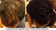 Men Hair Stem Cell Could Cure Baldness, Cost & Review Bangkok - Urban Beauty Thailand