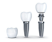 Dental Implants Are Highly Biocompatible with Your Body