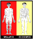 Smallpox Disease Overview