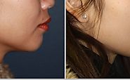 Best Chin Augmentation Surgery in India - Facial Plastic Surgeon India