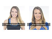 A Satisfied Patient's Experience: Rhinoplasty Results after Surgery