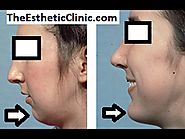 Chin Implant & Augmentation at Facial Plastic Surgeon India