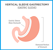 Affordable Gastric Sleeve Surgery Clinic in Perth