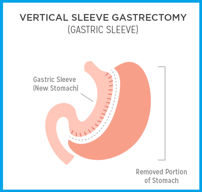 Gastric Sleeve Surgery, Perth, Australia | A Listly List