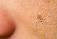 Ingrown Hairs-what are they? & How to treat. | Excellent Esthetics
