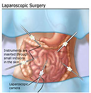 Laparoscopic Abdominoperineal Resection, Dr. Mohit Jain