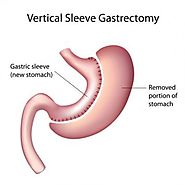 Sleeve Gastrectomy in Delhi - Dr. Mohit Jain