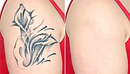 Traditional reasons for laser tattoo removal Melbourne