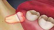 Các yếu tố ảnh hưởng đến giá nhổ răng khôn hàm dưới