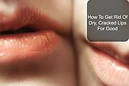 How To Get Rid Of Dry Lips For Good - wherefitnessmeetsbeauty