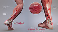 Achilles Tendonitis vs Tennis Leg