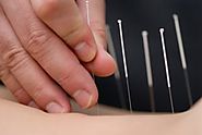Acupuncture in Mississauga By Lucie Medispa