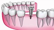 Captivate Dental - Cosmetic & General Dental Implant Solutions