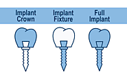 Some Basic Information about Dental Implant Melbourne