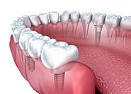 Dental implant Melbourne delivers committed solutions for every generation