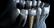 Things To Know About Dental Implants Melbourne | Captivate Dental