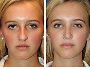 Nose Reshaping (Rhinoplasty) Case Studies