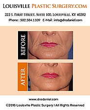 Lip Enhancement - Dr. O Daniel