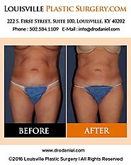 Liposuction and Laser Liposuction