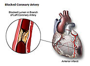 What is Angina? Symptoms, Diagnosis and Treatment - hmedical