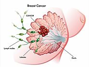 Breast Cancer Symptoms, Causes and Treatment - hmedical