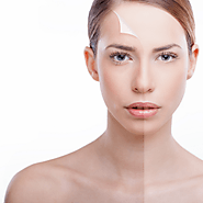 Chemical Peels brisbane