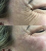 Cost-Effective Anti Wrinkle Injections Treatment In Brisbane