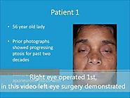 Best Droopy Eyelid Ptosis Surgery in India by Cosmetic Oculoplasty Surgeon- Dr. Debraj Shome
