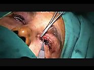 Best Ptosis Eyelid Surgery in India by Oculoplastic Surgeon Dr. Debraj Shome