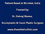 Botox Treatment (Botulinum Toxin Injections) Blepharospasm & Hemifacial Spasm in India
