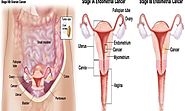 Ovarian Cancer, The Silent Killer, And What You Need To Watch Out For -