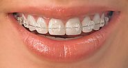 5 Best Places to Get Dental Braces in Houston Texas | Vita Dental Care