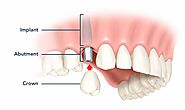 How Much Does A Dental Implant Cost In Houston Texas | Vita Dental Katy