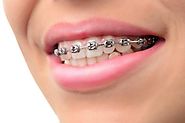 Find The High Quality Dental Braces at affordable Price in Houston Texas