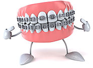 3 Factor That Determine the Cost of Dental Braces | Vita Dental Houston