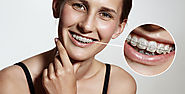 Getting Dental Braces- 10 Important Things You Should Know