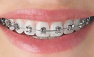 Know Top 10 Things about Dental Braces and Retainers | Vita Dental Katy