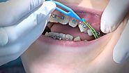 10 Reasons People Are Rushing To Get Dental Braces | Katy Dentist Care